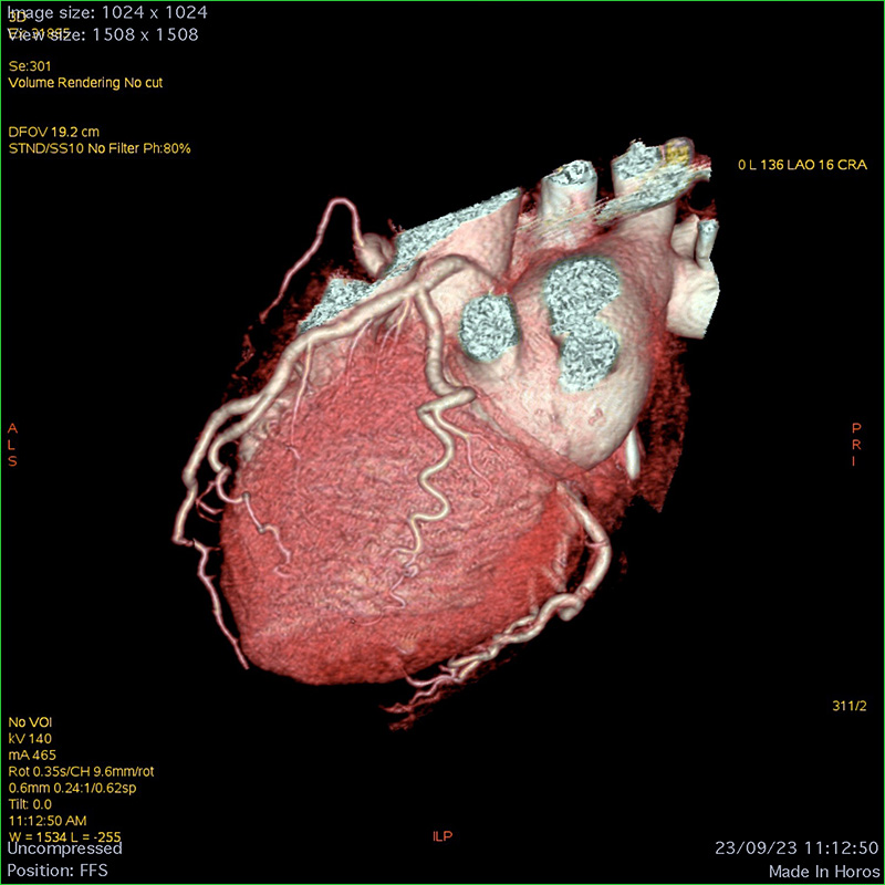 (CT) Coronary Angiogram