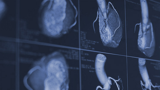 Coronary Calcium Scan